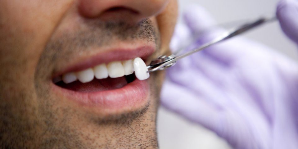 Lente de Contato Dental - Consultório Paula Machado SP