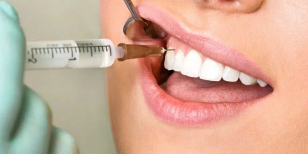 Saiba tudo sobre anestesia local odontologica