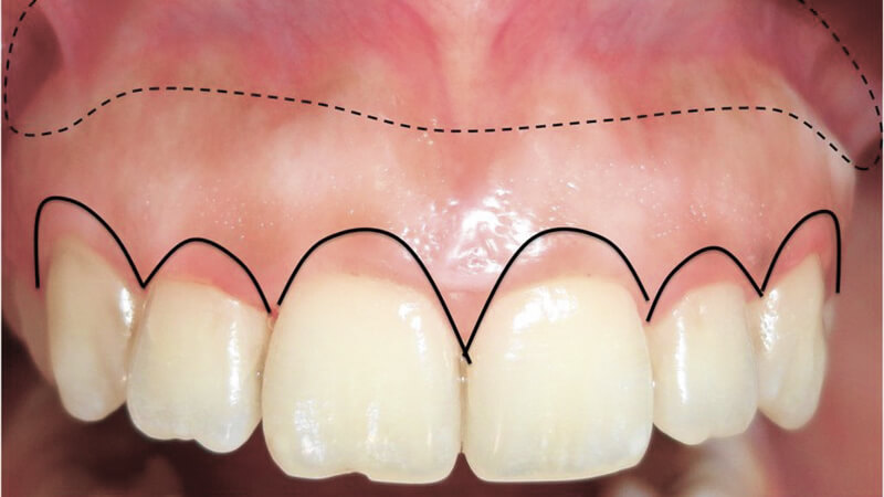 Cirurgia: Aumento de coroa clínica