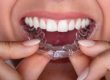 O que é Invisalign