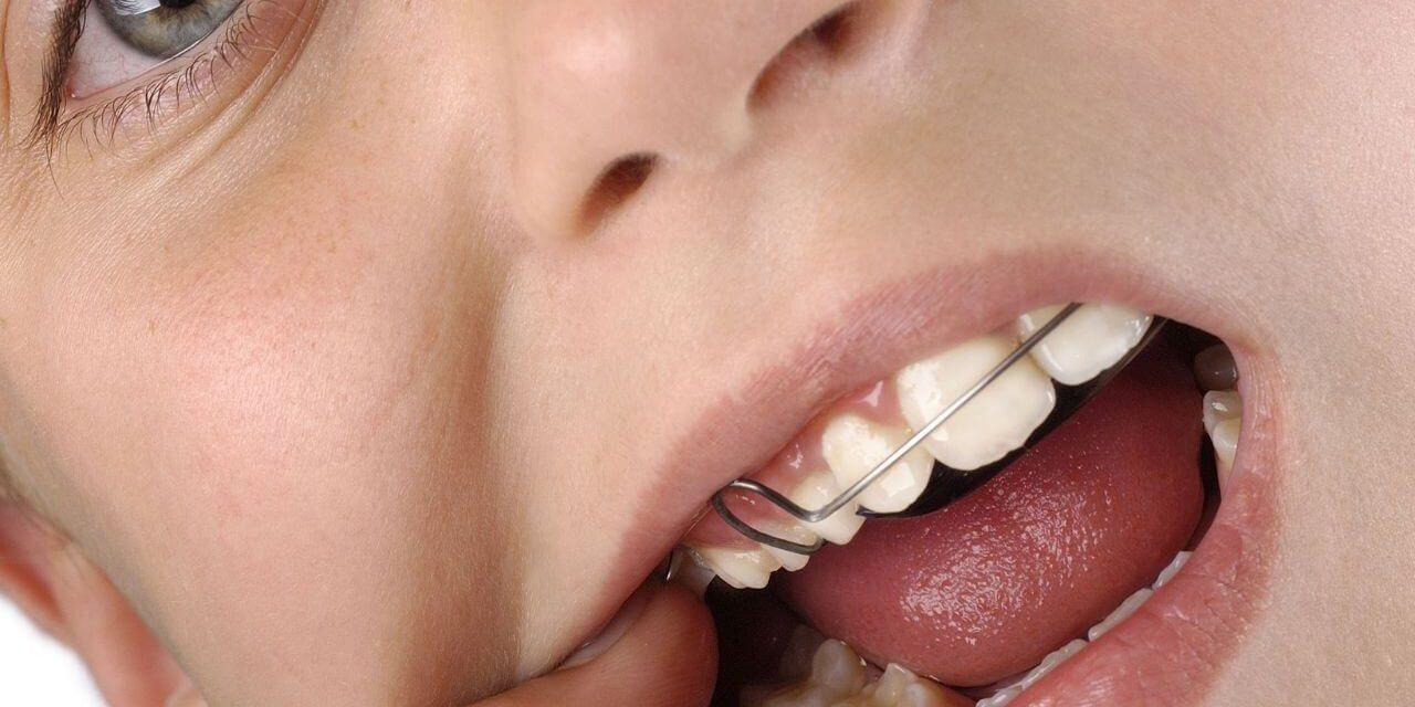Tudo sobre Contenção Dentária